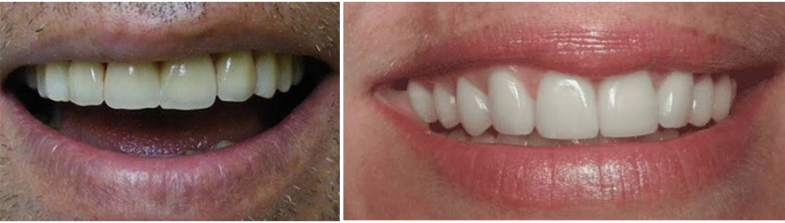 Zirkonyum Beyaz Diş Tedavi
